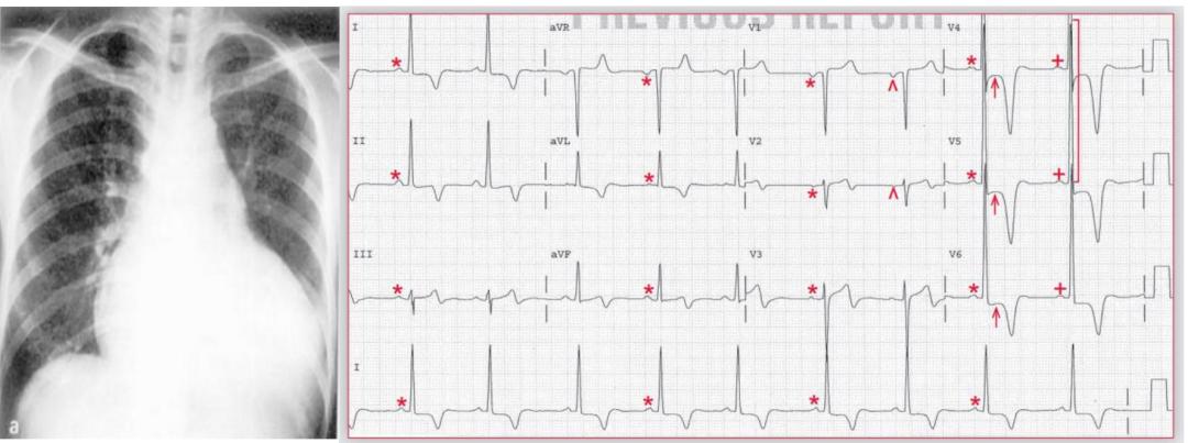 心电图笔记26：QRS波振幅变高，需要想到哪些