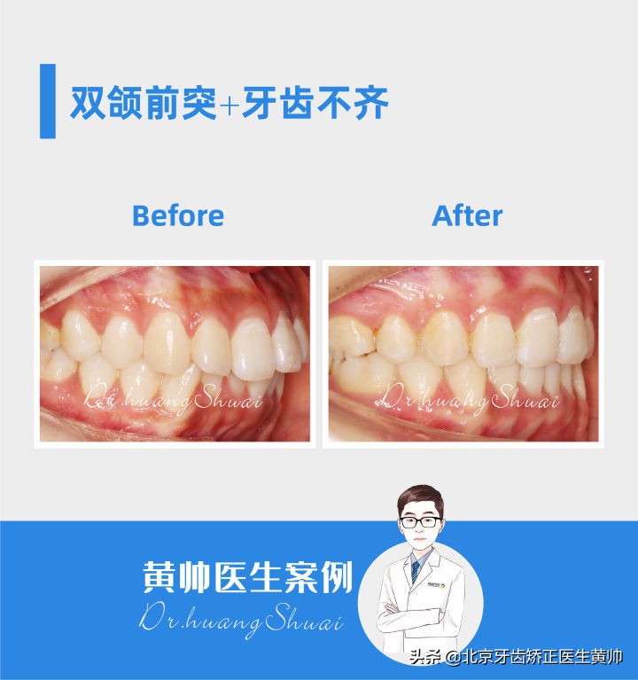 嘴凸的人怎么笑起来好看,嘴型比较凸的人怎么改善