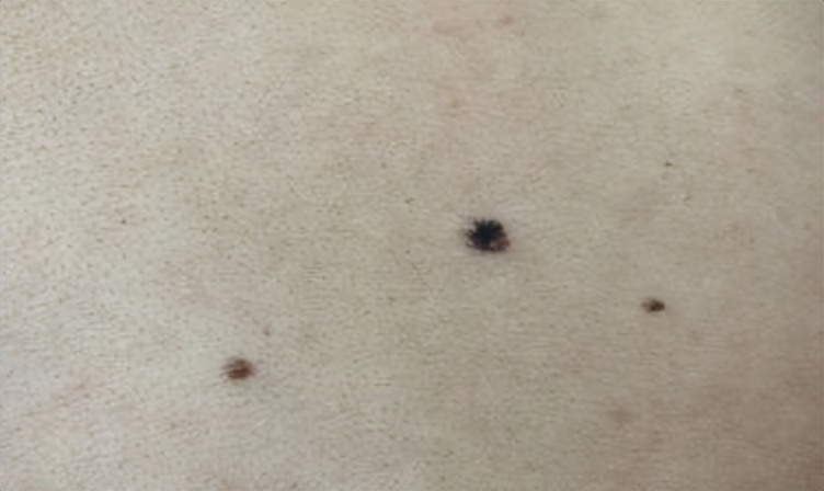 黑痣长在脸上各部位代表什么图片,医生说黑痣有癌变的可能怎么办