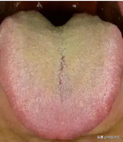 气虚自汗吃玉屏风散有用吗,头脸爱出汗吃玉屏风散有用吗