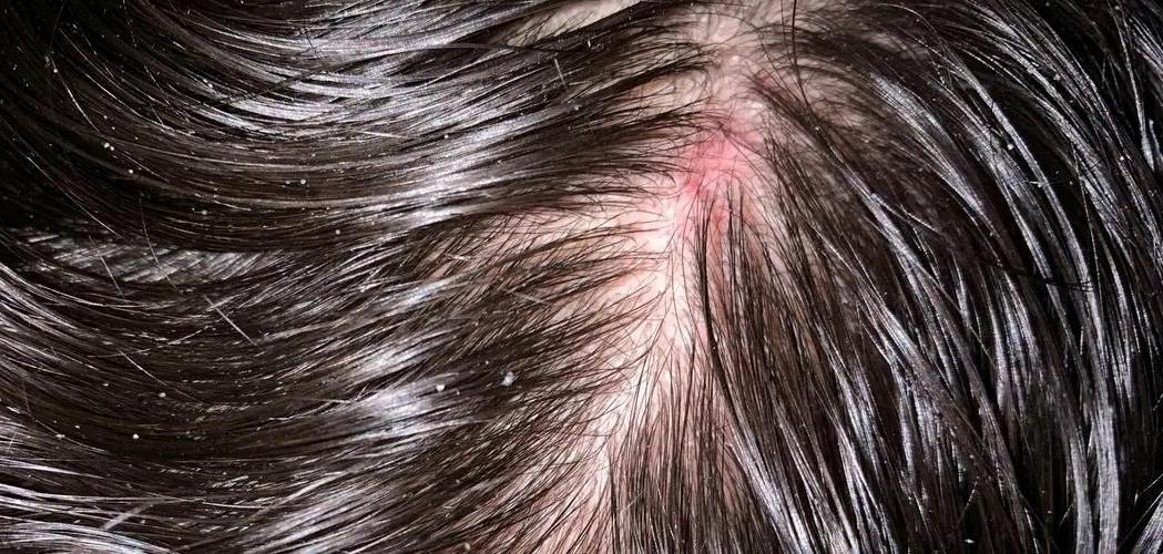 头皮总是长疙瘩是怎么回事,头皮上老长疙瘩怎么回事