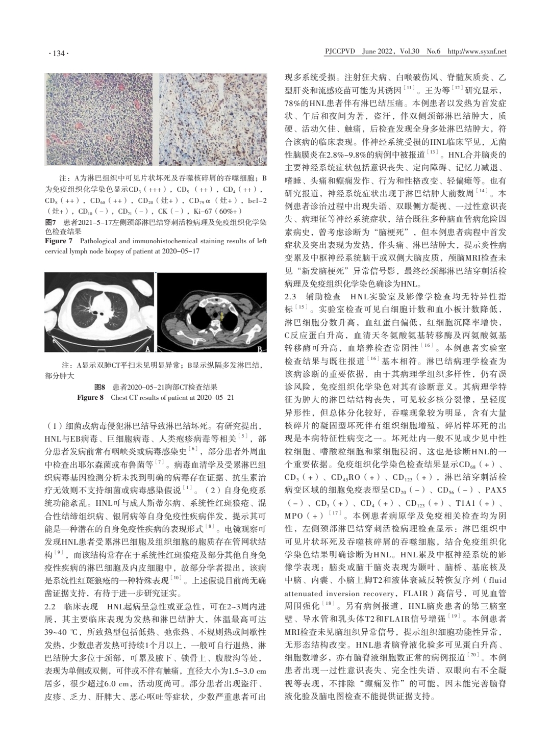 伴神经系统受损的组织细胞坏死性淋巴结炎一例报道并文献复习