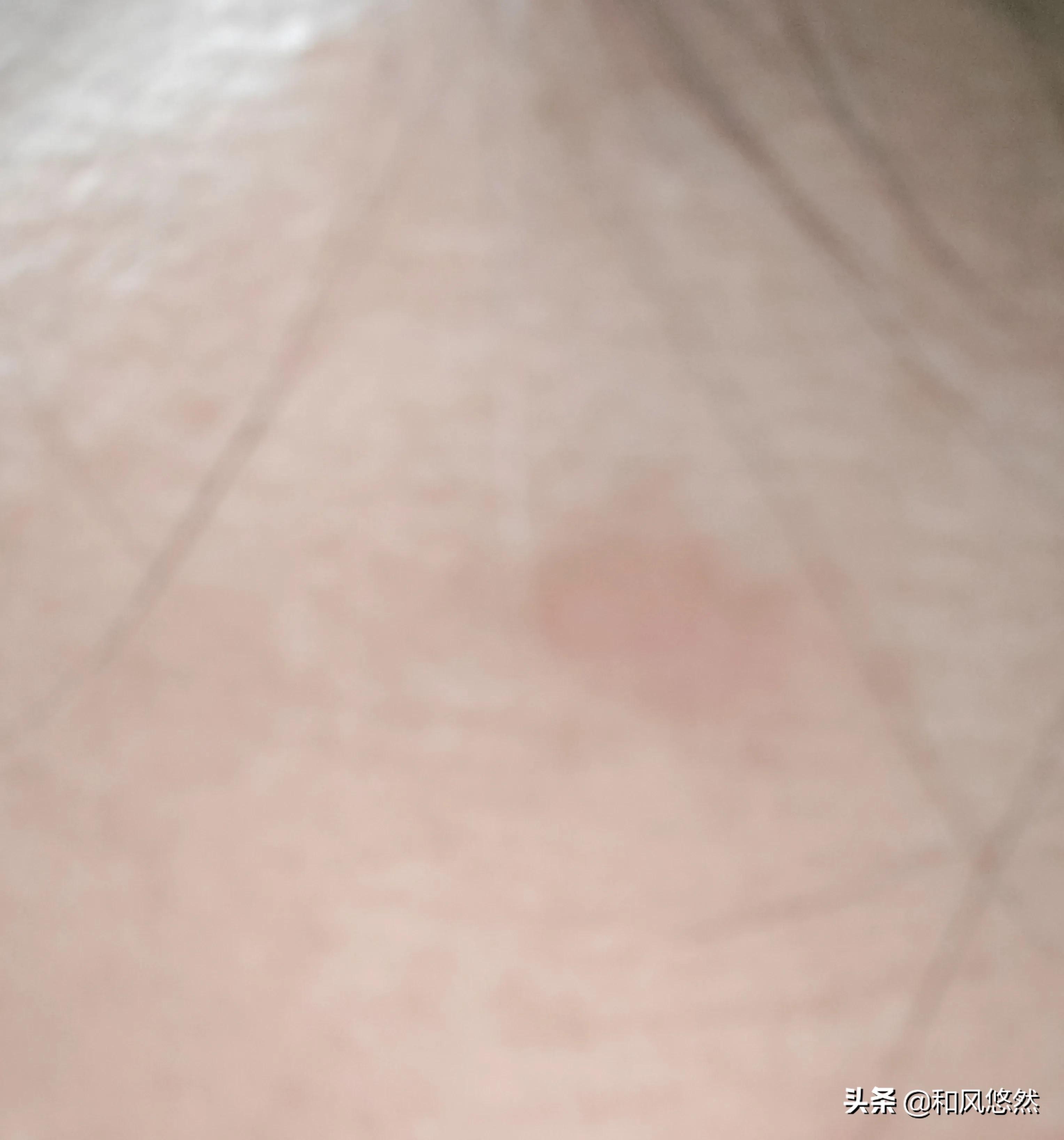 祛斑真实有效推荐,快速祛斑易出现哪些副作用