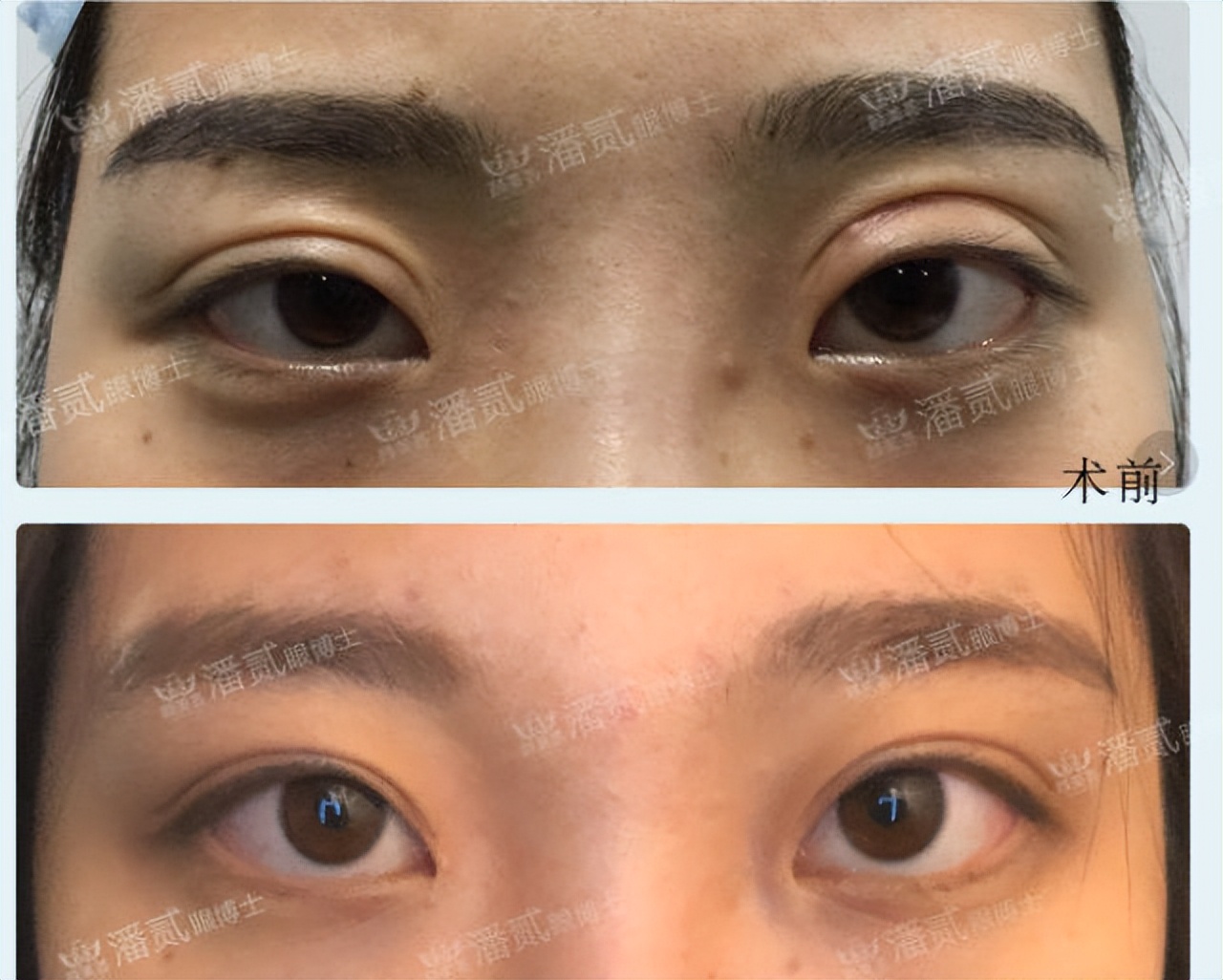 埋线双眼皮如果不满意怎么修复,切开双眼皮失败可以用埋线修复吗