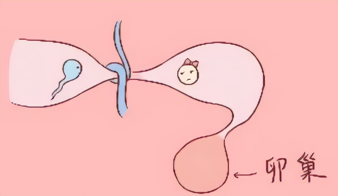 结扎的女性卵子怎么排出来的,女性结扎之后卵子如何排出