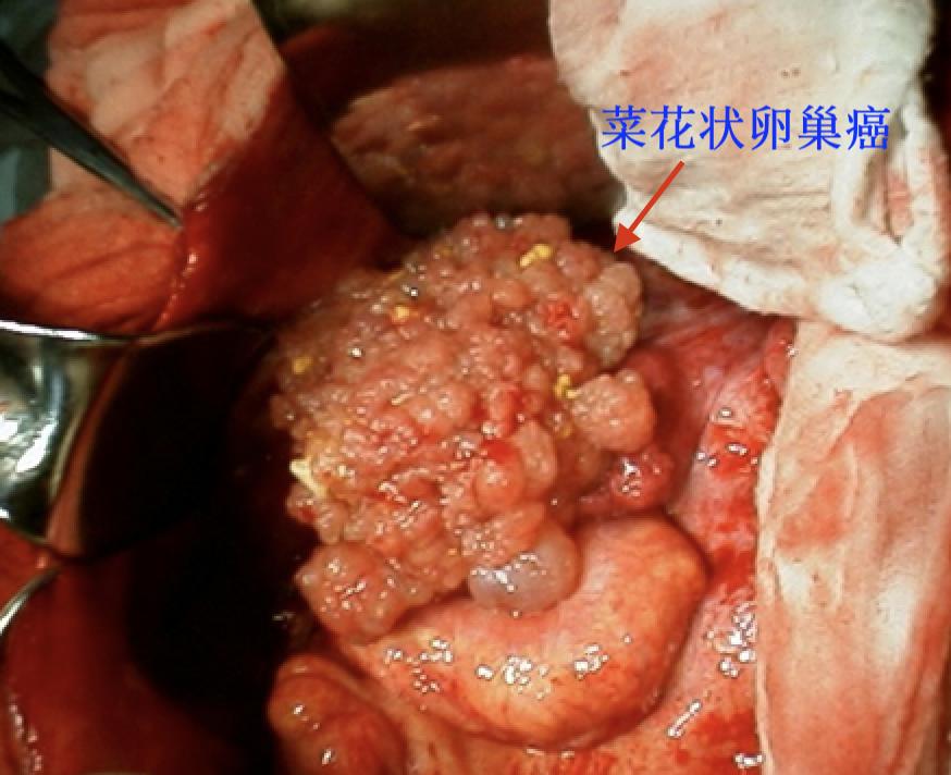 超声显示子宫肌瘤卵巢囊肿,显微镜下的卵巢囊肿