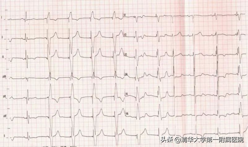 如何预防起搏器综合征,起搏器综合征危害处理