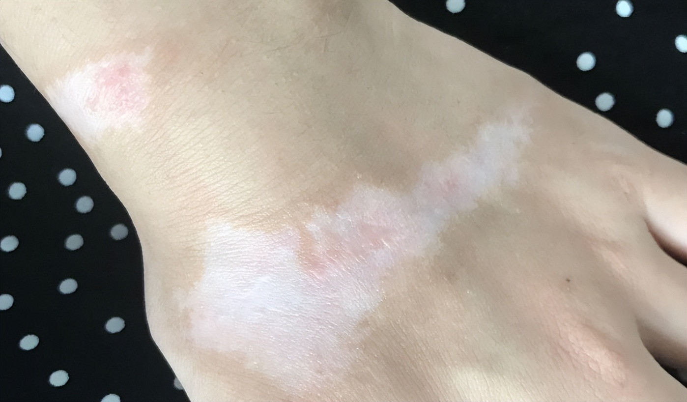 色素疤痕和烫伤疤痕,烧烫伤疤痕好治还是刀伤疤痕好治