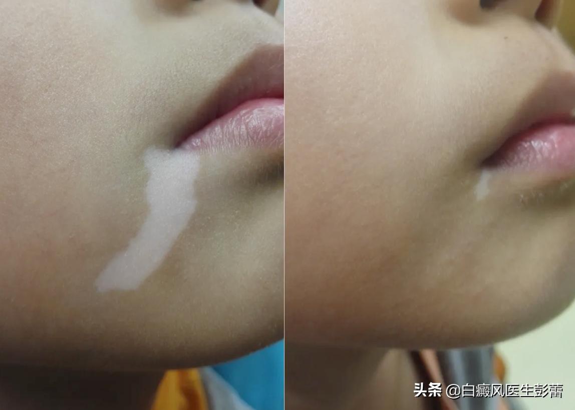 白斑是怎样逐步复色的？这几种复色方式你一定要了解