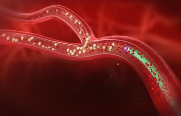 微球治疗肝癌能活多久,90微球治疗肝癌普及了吗