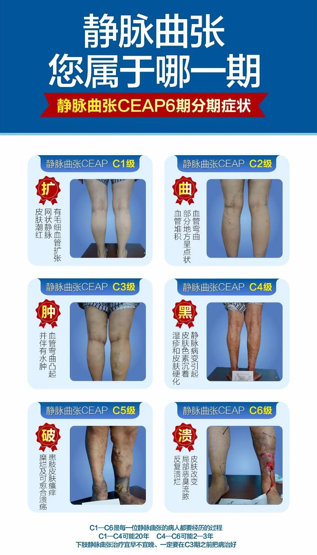 男子治疗静脉曲张视频,陕西省第一中医院治疗静脉曲张