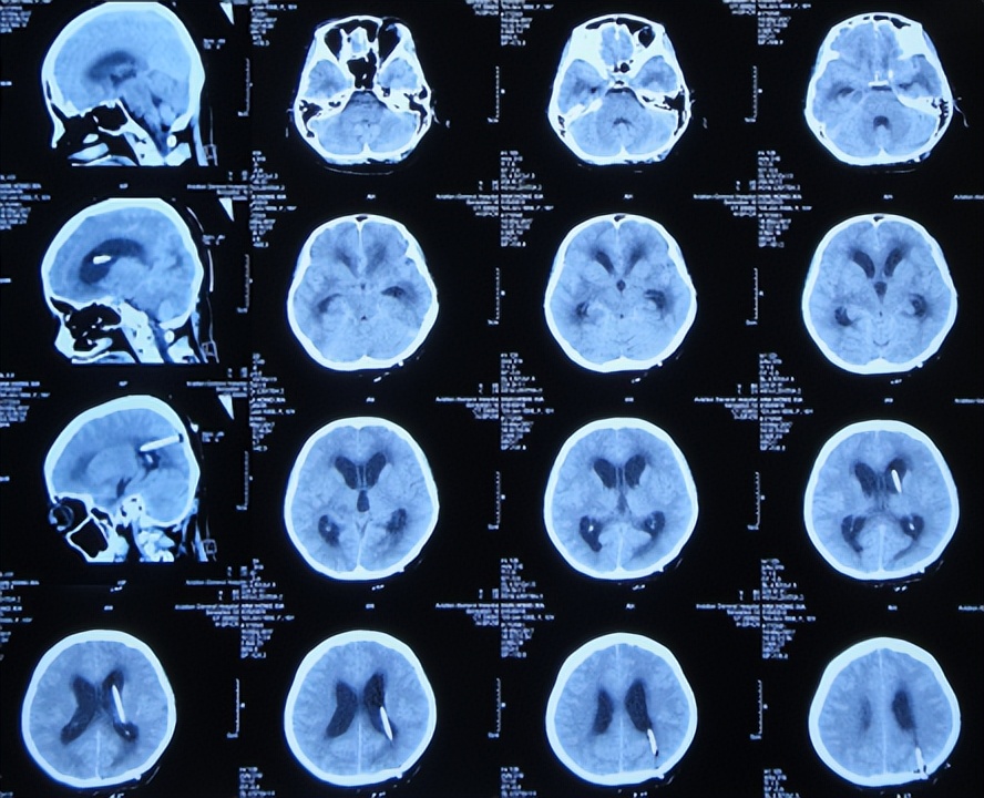 结核性脑积水能治愈吗,儿童结核脑膜炎脑积水