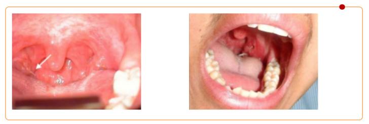 协和耳鼻喉科取鱼刺要多少钱,误吞鱼刺在咽喉多久判断没事