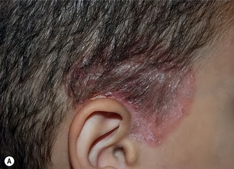 头皮脂溢性皮炎头皮红有皮屑,脂溢性头皮皮炎需要怎么治疗