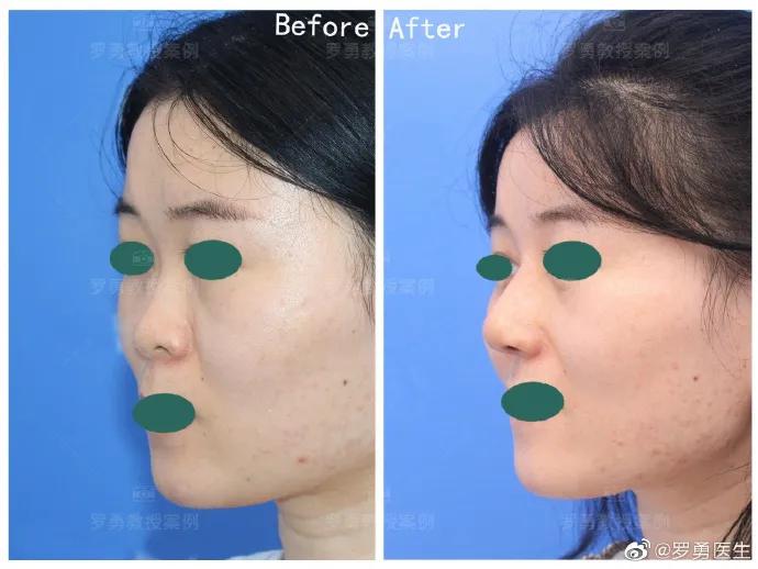 鼻综合鼻头挛缩山根太高怎么修复,鼻综合后山根太低