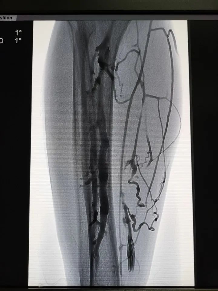 静脉曲张的福音！下肢静脉腔内微波消融闭合术，效果到底怎么样？