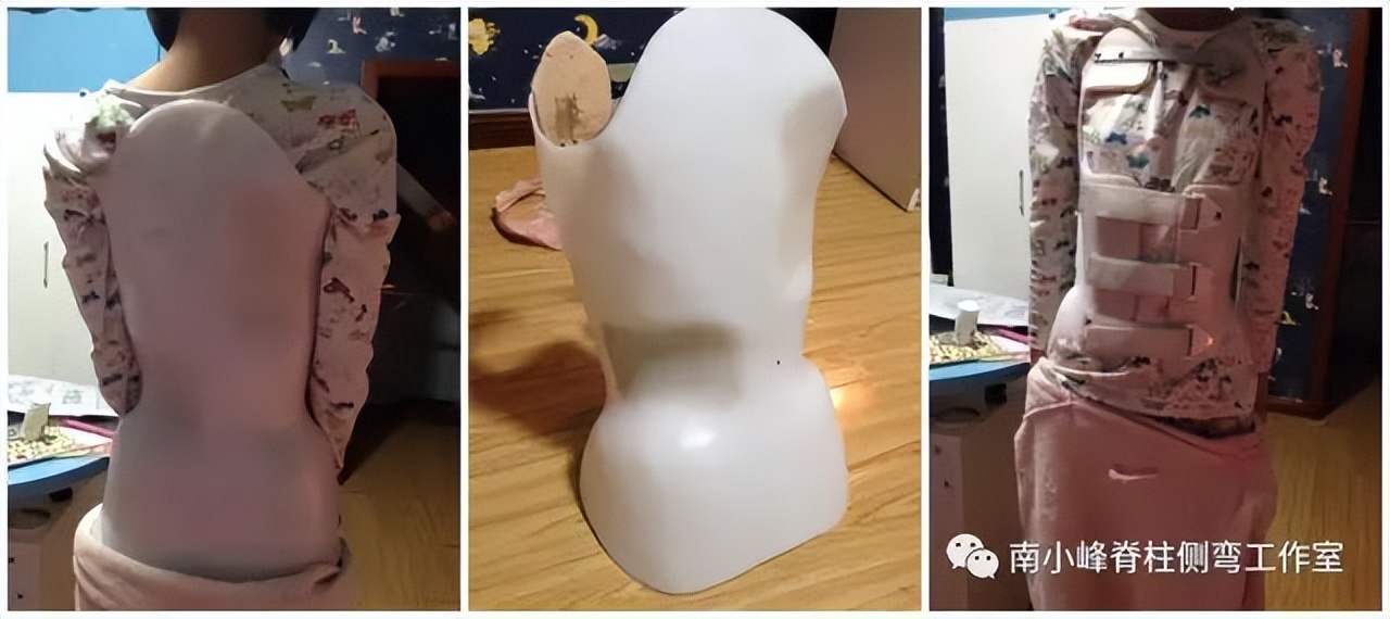 脊柱侧弯矫正支具不调整会怎样,简单辨别脊柱侧弯避免孩子走弯路