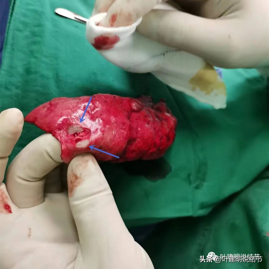 中叶多发微小结节,男性30岁右侧甲状腺单发结节