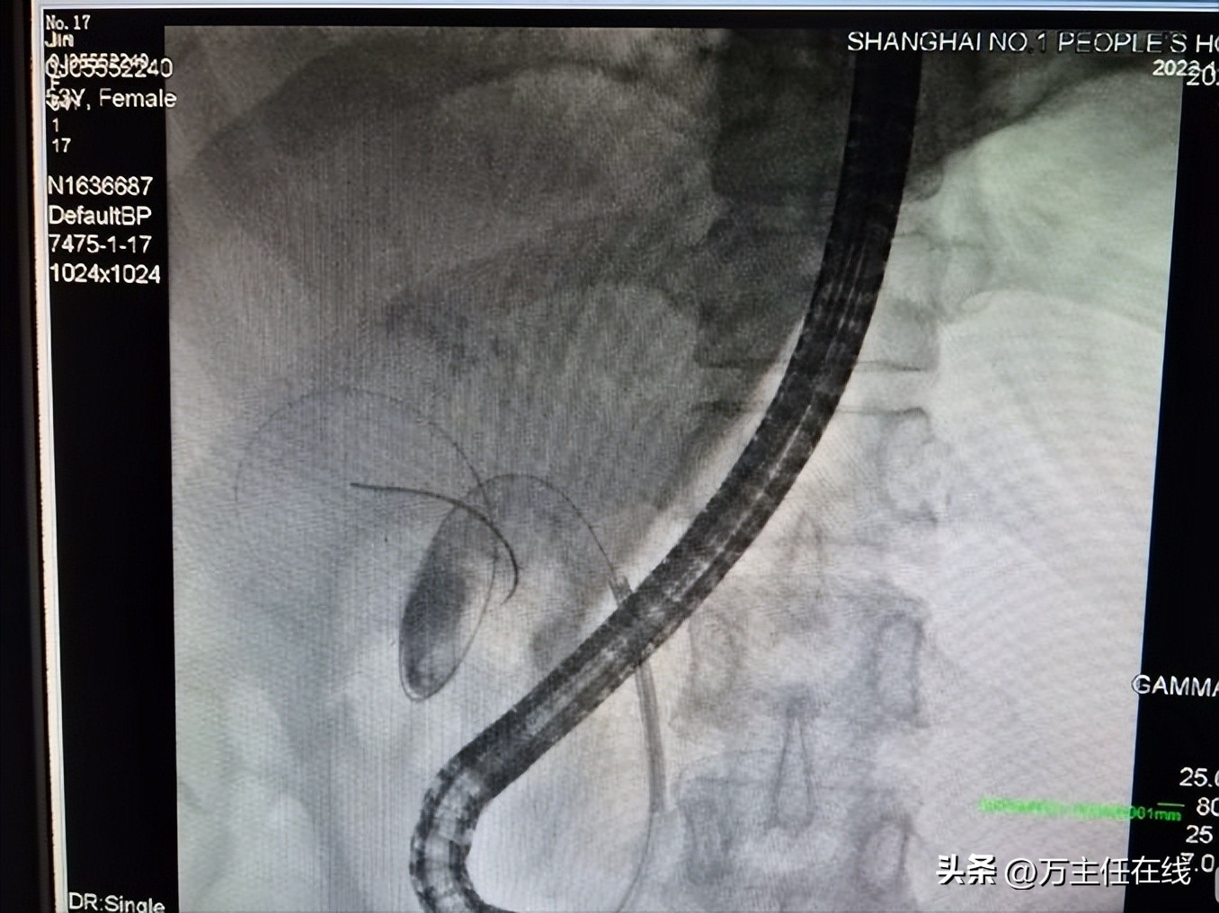 胆结石化脓性胆囊炎,妙手神针巧治疑难杂症