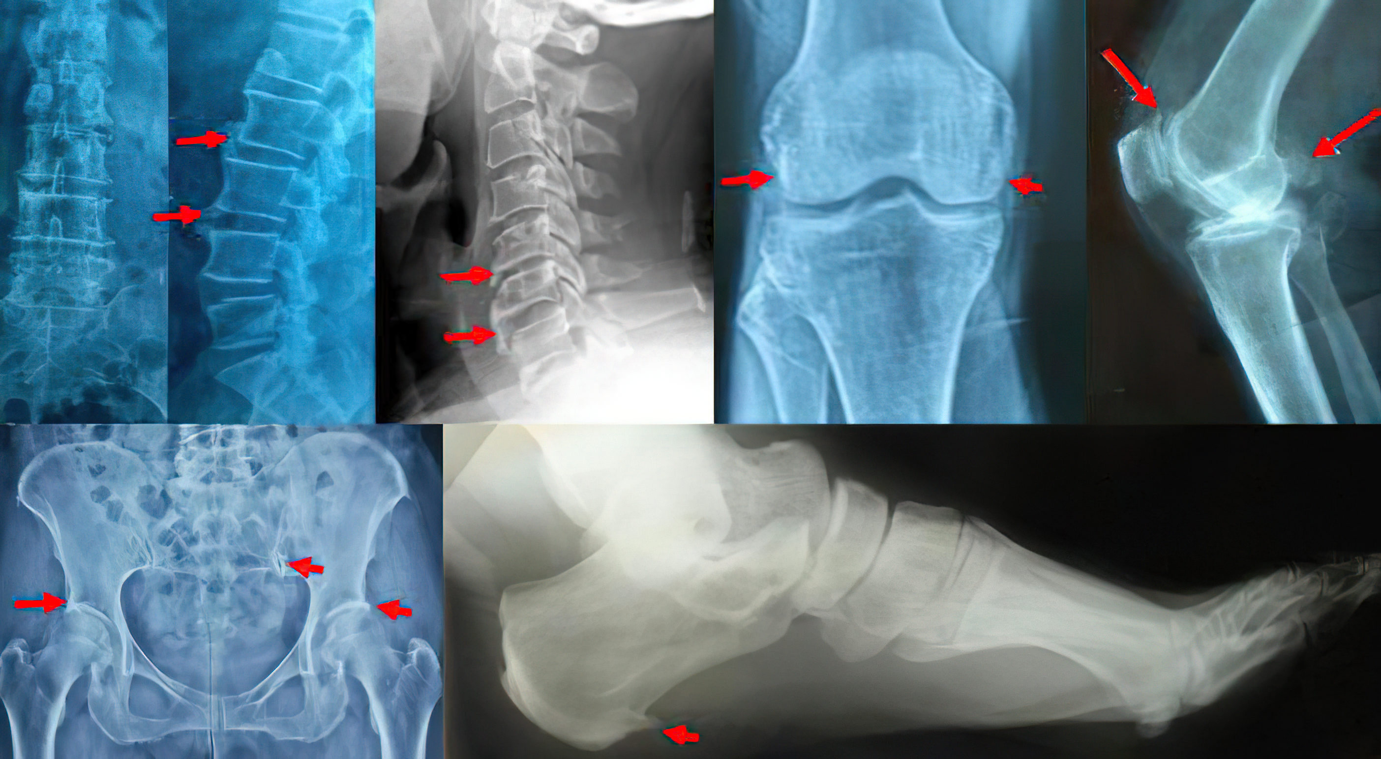治疗风湿病的药能治疗骨刺吗,关节长骨刺是痹症吗