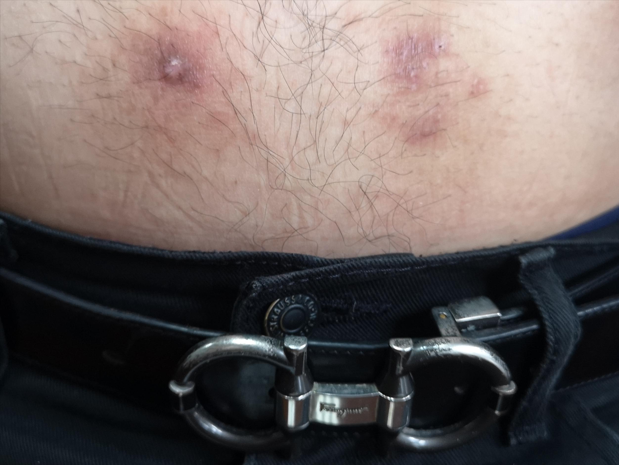 对镍过敏是怎么回事,镍过敏的人多不多