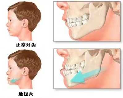 儿童牙齿反颌有什么危害,婴幼儿反颌怎么鉴别