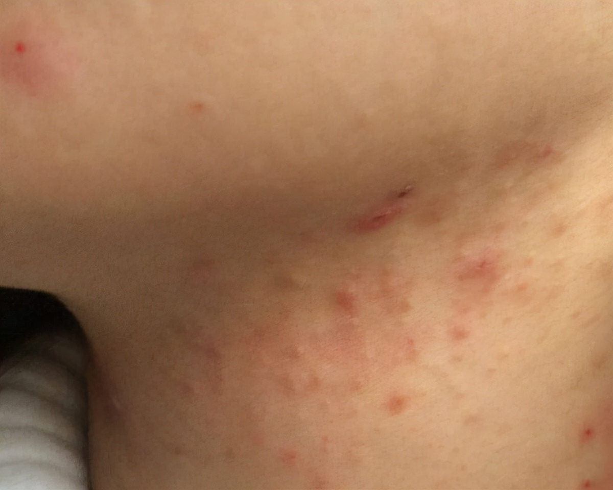 脖子上长痘痘怎么办男生,脖子上长痘痘怎么办