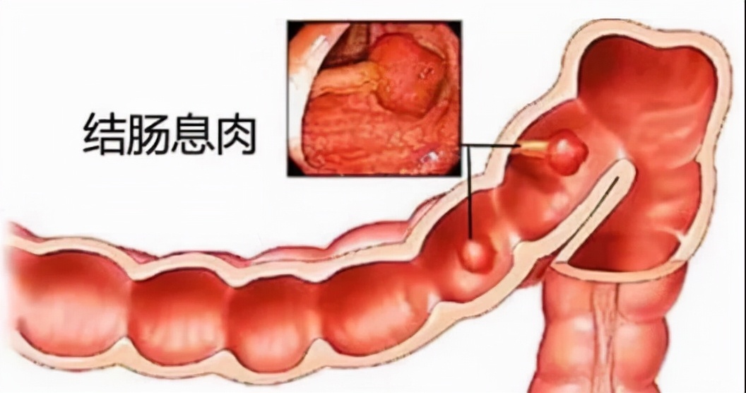 息肉结节肌瘤囊肿分别是什么意思,囊肿息肉结节能自己消除吗
