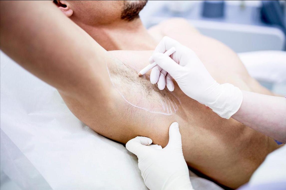 狐臭不敢接近人群，被孤立怎么办？医生：有4种方法减轻狐臭