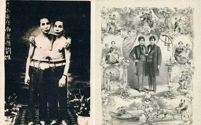 连体人结婚是怎样过日子,连体人如何娶妻生子