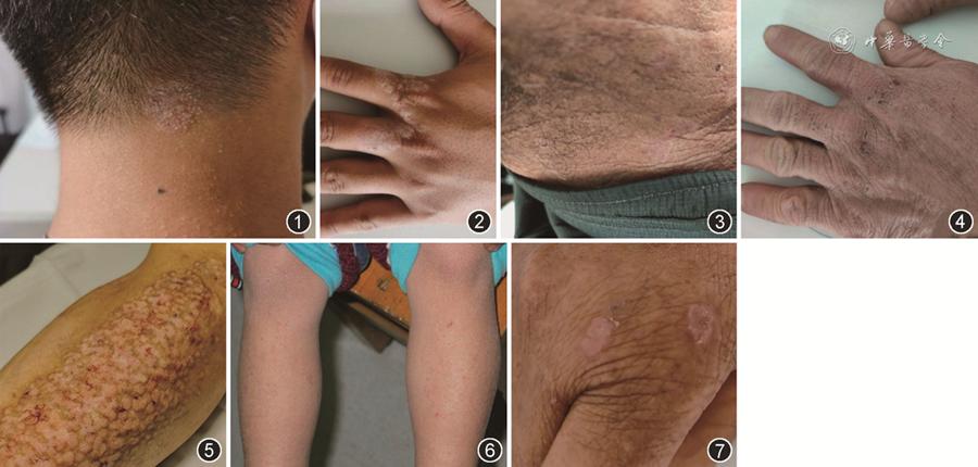 神经性皮炎发病率是多少,神经性皮炎的临床诊断和治疗