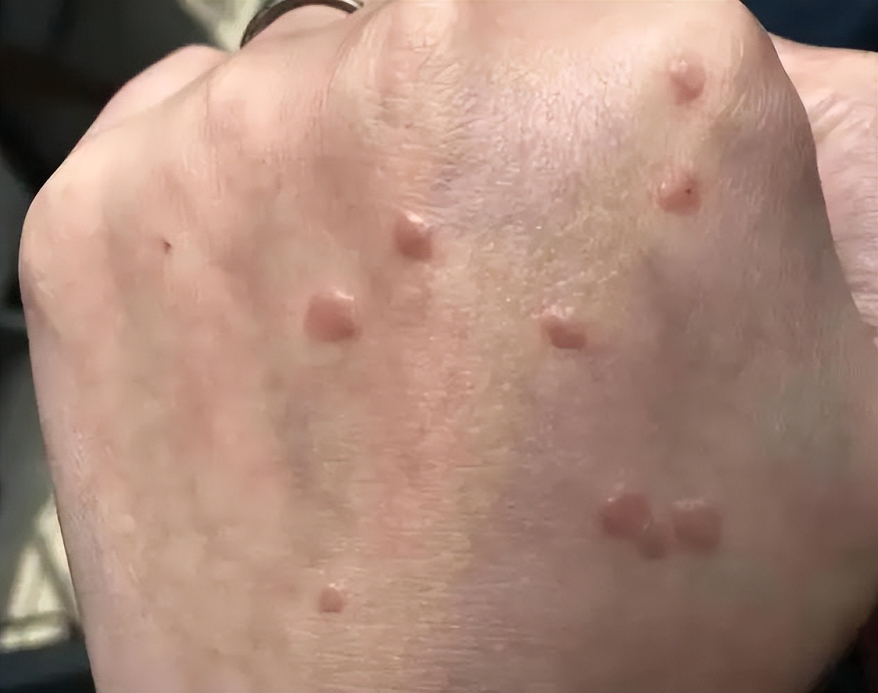 hpv感染出现这3个征兆请立即就医,HPV感染提示是什么意思