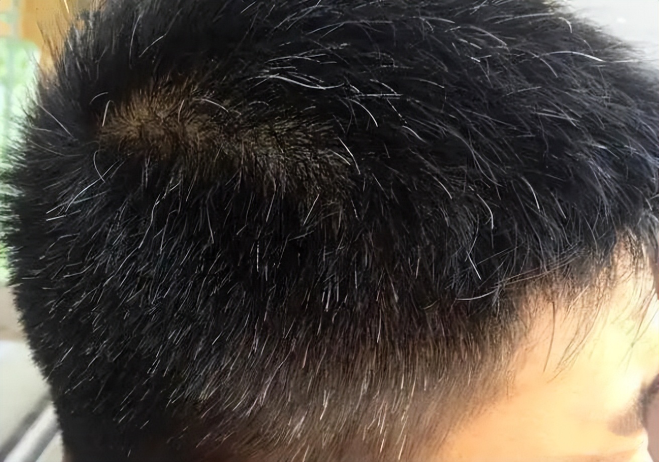 白头发通常是哪个部位开始变白,白头发的不同位置的原因