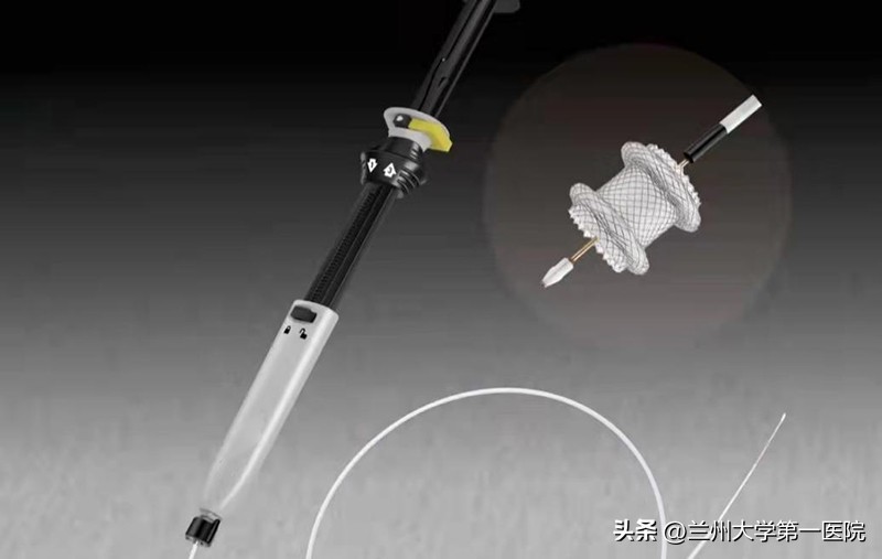 兰大一院成功应用“HOTAXIOS”系统开展超声内镜引导下胰周包裹性积液穿刺置管引流术