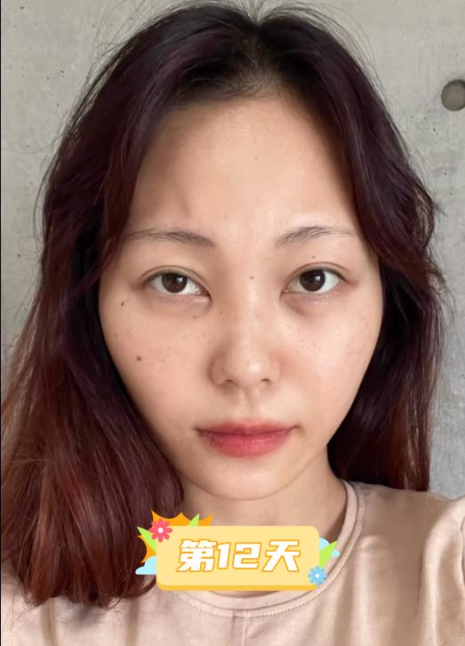 内切去眼袋手术全过程,做了去眼袋手术五天怎么还有眼袋