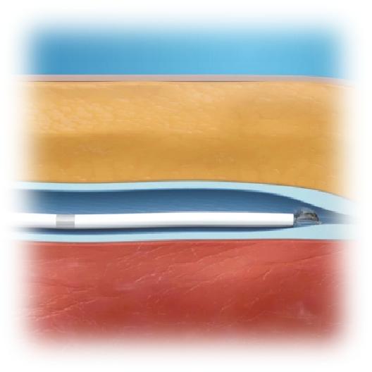 比微创介入更高级的手术,血管万能胶