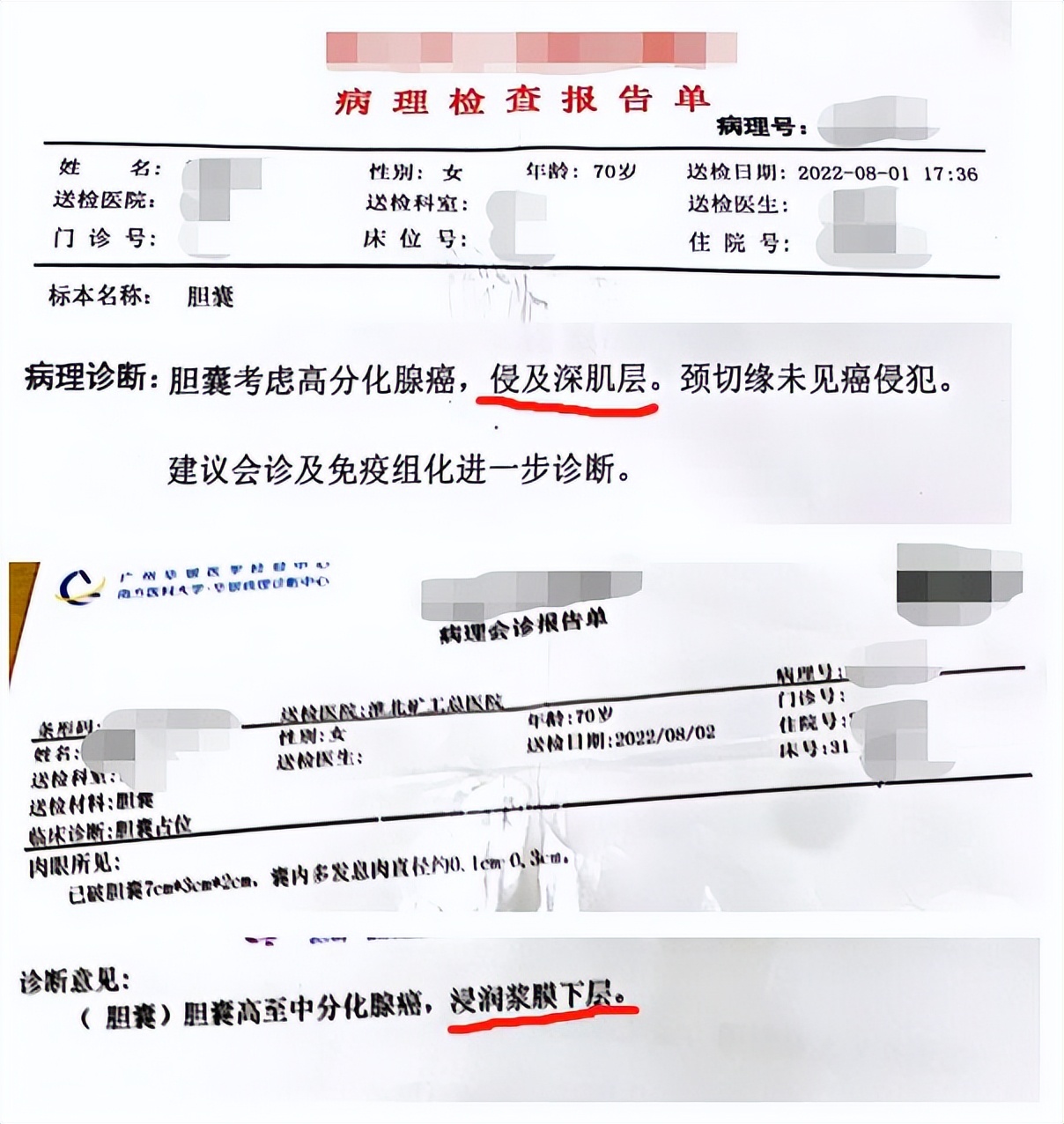 胆囊癌术后病理切片报告,胆囊癌手术后化疗情况怎样