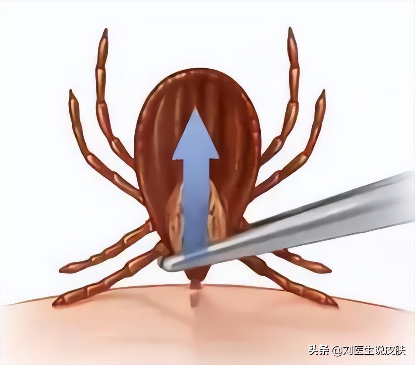 蜱虫可传播多种致命疾病,蜱虫叮咬可引起哪些疾病