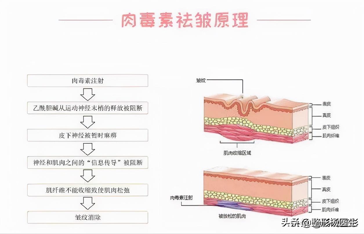 水光针能去除眼部细纹吗,菲洛嘉水光针可以去除细纹吗