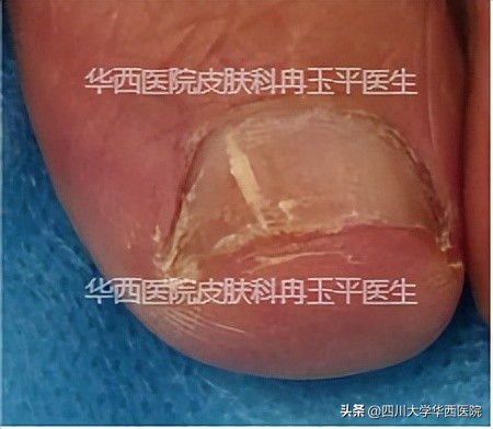 得了灰指甲是指甲变灰吗,灰指甲增厚变黑是灰指甲吗