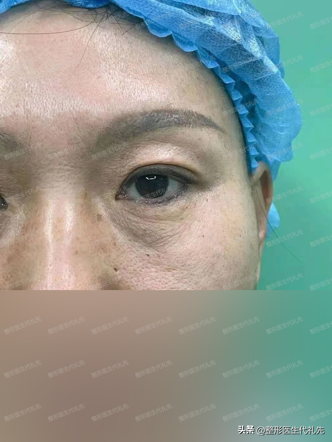 55岁女士做双眼皮能转运吗,北京双眼皮眼袋手术