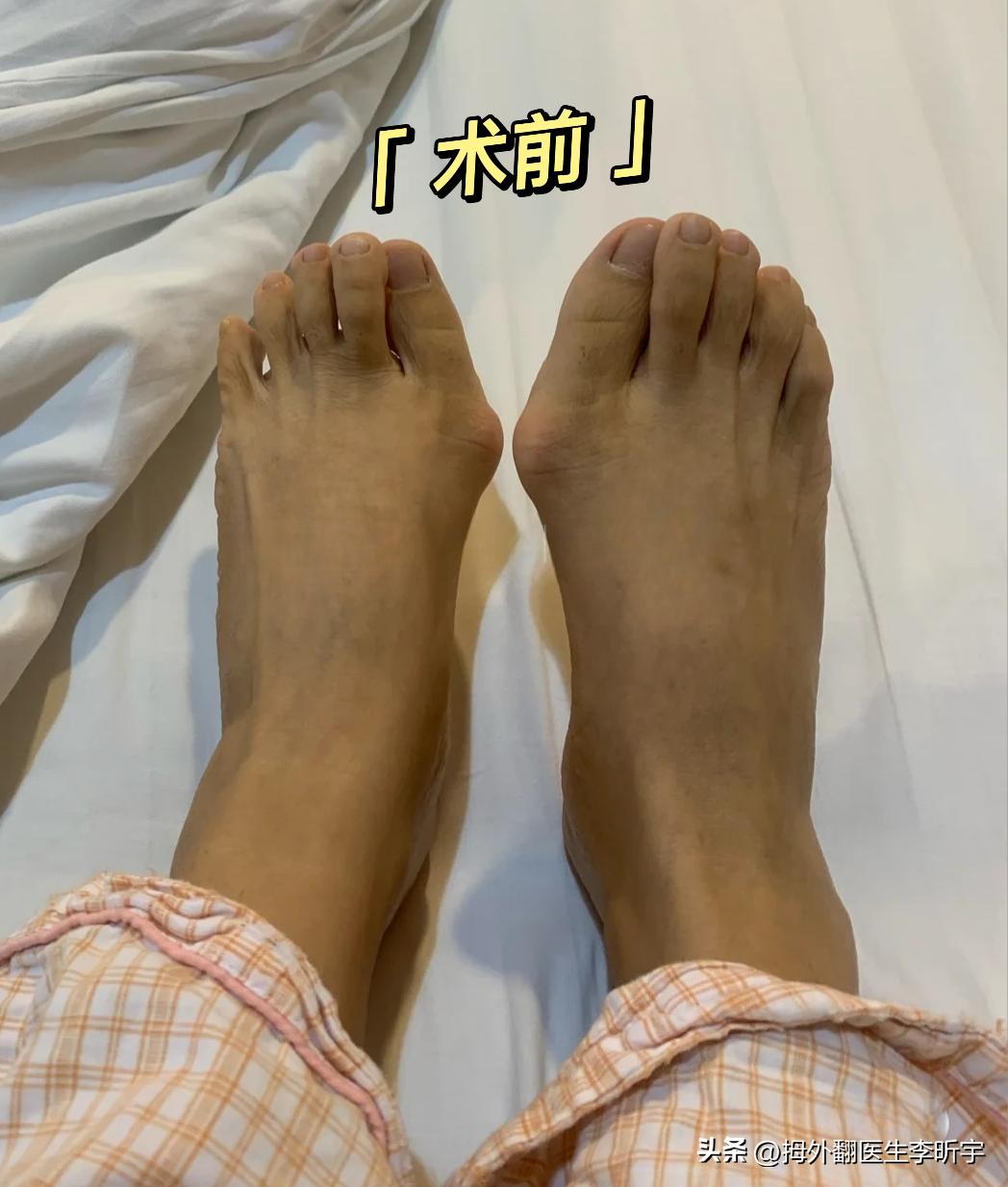 「案例分享」摆脱了多年的大脚骨，我现在是越看越喜欢！