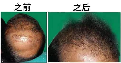 私部毛囊可以植发吗,腋窝的毛可以植发吗