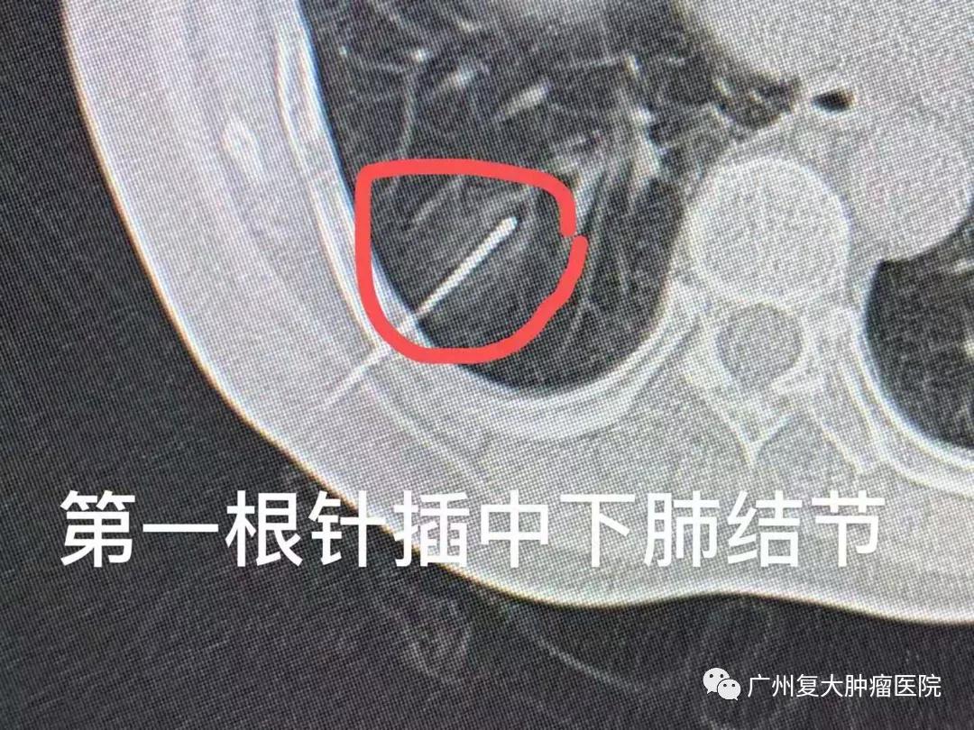 肺结节该观察还是手术？或许微创消融治疗是个不错的选择