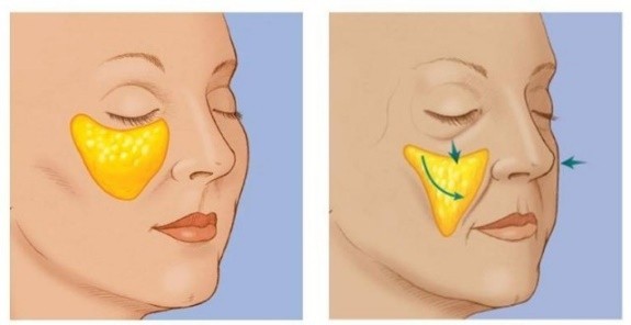 法令纹泛红暗沉做什么医美,法令纹早睡早起消除得了吗