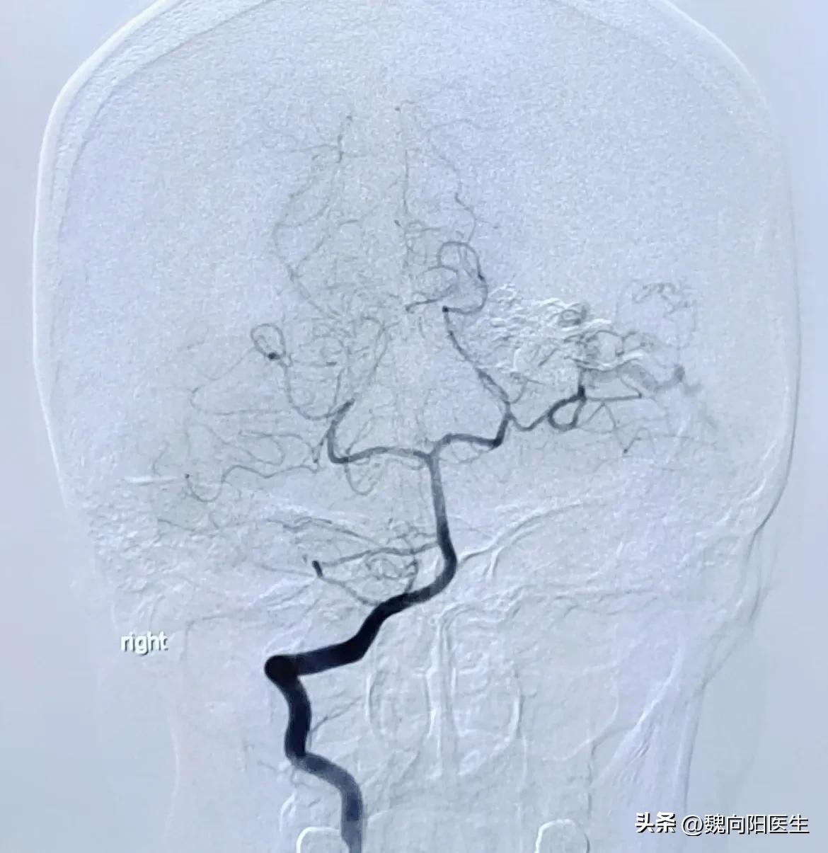 脑出血后的患者,脑出血患者好转的现象