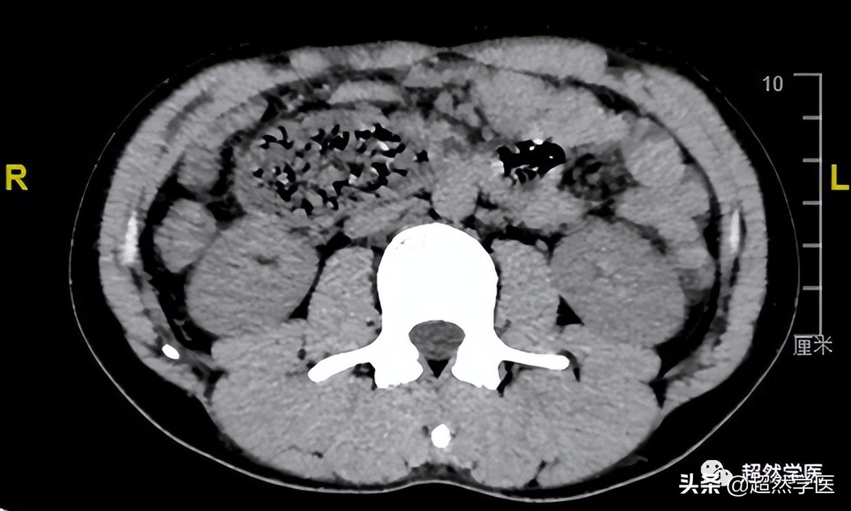 十二指肠球部狭窄导致呕吐,十二指肠降部隆起梗阻呕吐
