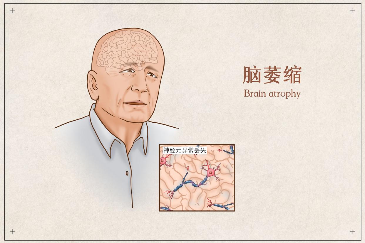 大脑萎缩严重时会产生什么后果,大脑在慢慢的萎缩是什么症状