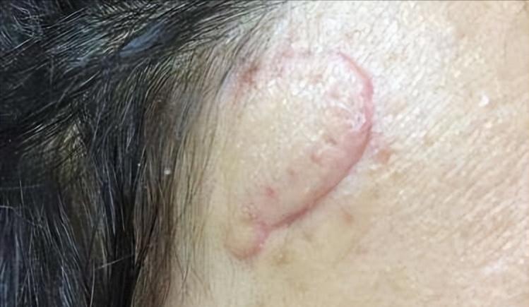 鼻子的黑头跟草莓一样,草莓黑头怎么去除最有效