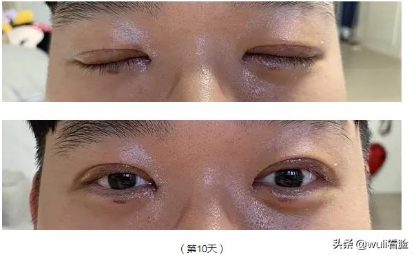 男生割双眼皮的意思,男生眼睛小割双眼皮会好看吗